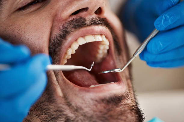 Laser Dentistry in Fairbanks Ranch, CA